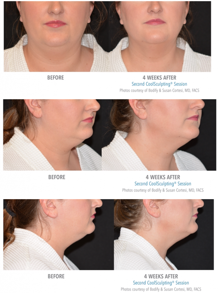 Coolsculpting Chin Before And After Pictures PictureMeta